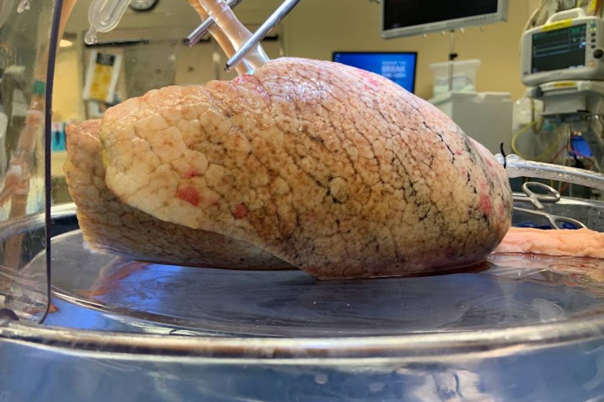 Pulmón perfundido 'ex vivo' con un tratamiento enzimático que convierte el órgano en un tipo sanguneo universal. (FOTO: UHN).